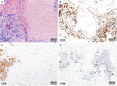 Cellular Signaling Pathways in Medium and Large Vessel Vasculitis